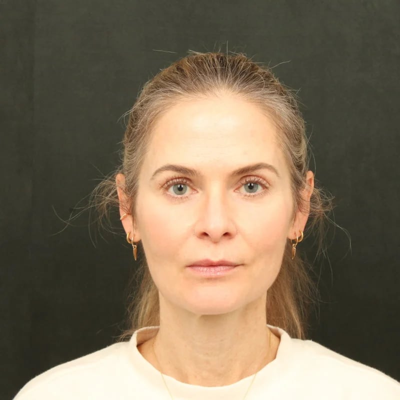Deep Plane Facelift & Neck Lift Before & After Image
