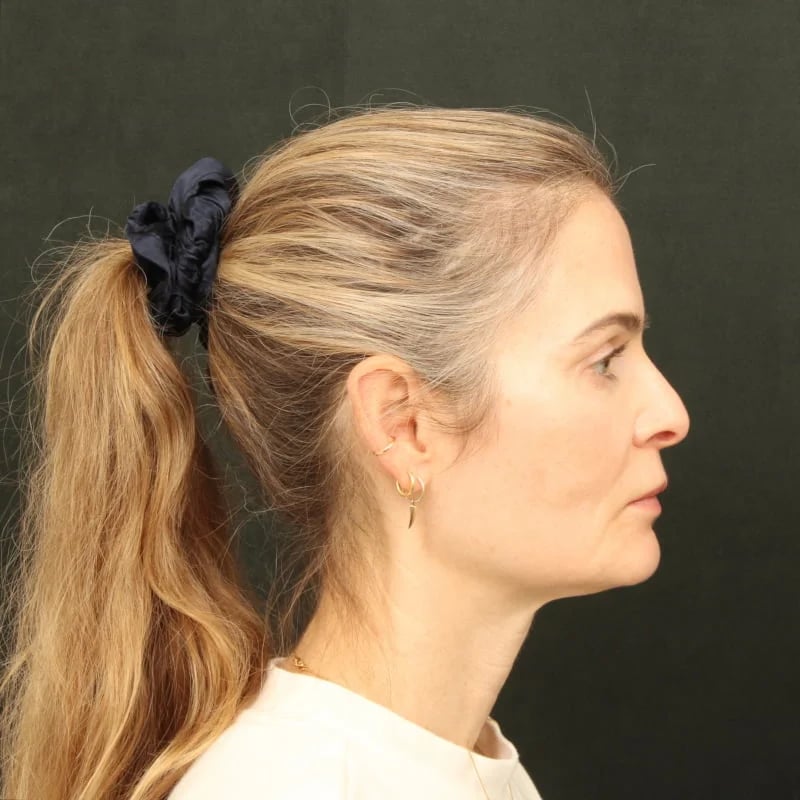 Deep Plane Facelift & Neck Lift Before & After Image
