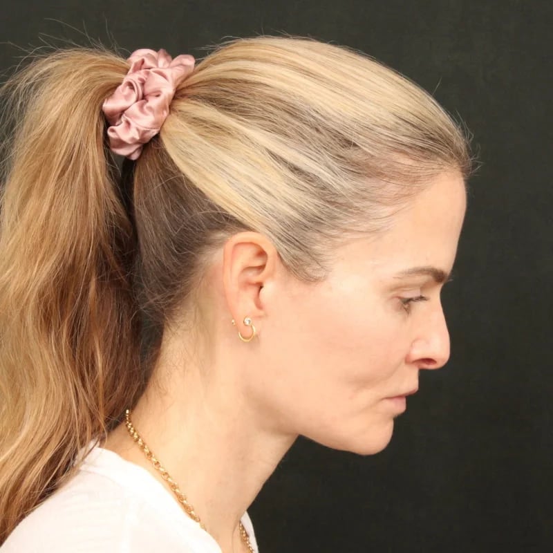 Deep Plane Facelift & Neck Lift Before & After Image