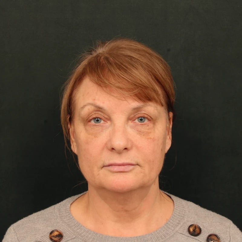 Deep Plane Facelift & Neck Lift Before & After Image