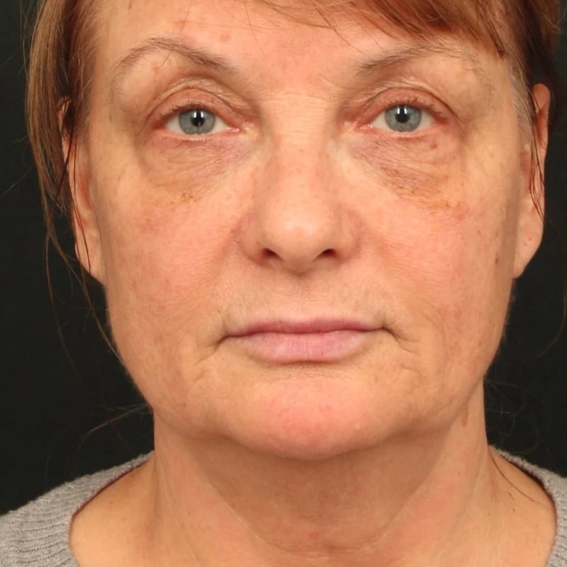 Deep Plane Facelift & Neck Lift Before & After Image