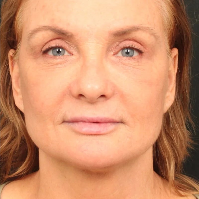 Deep Plane Facelift & Neck Lift Before & After Image