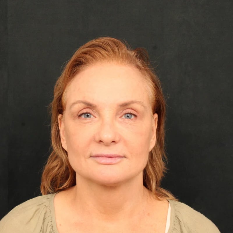 Deep Plane Facelift & Neck Lift Before & After Image