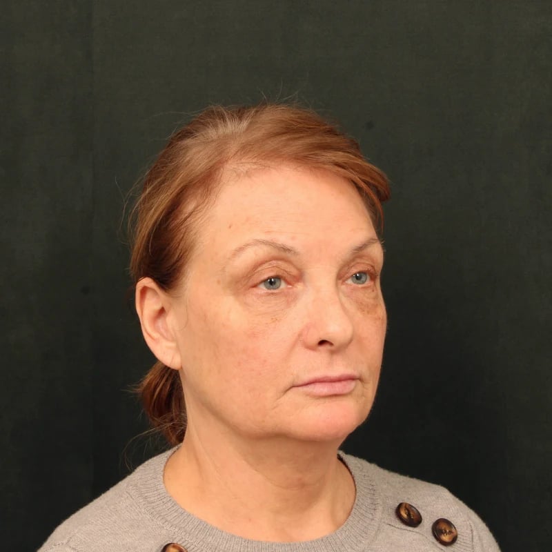 Deep Plane Facelift & Neck Lift Before & After Image
