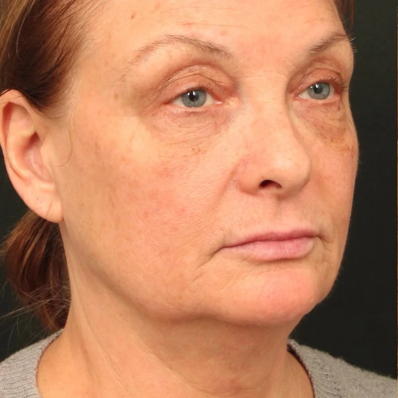 Deep Plane Facelift & Neck Lift Before & After Image