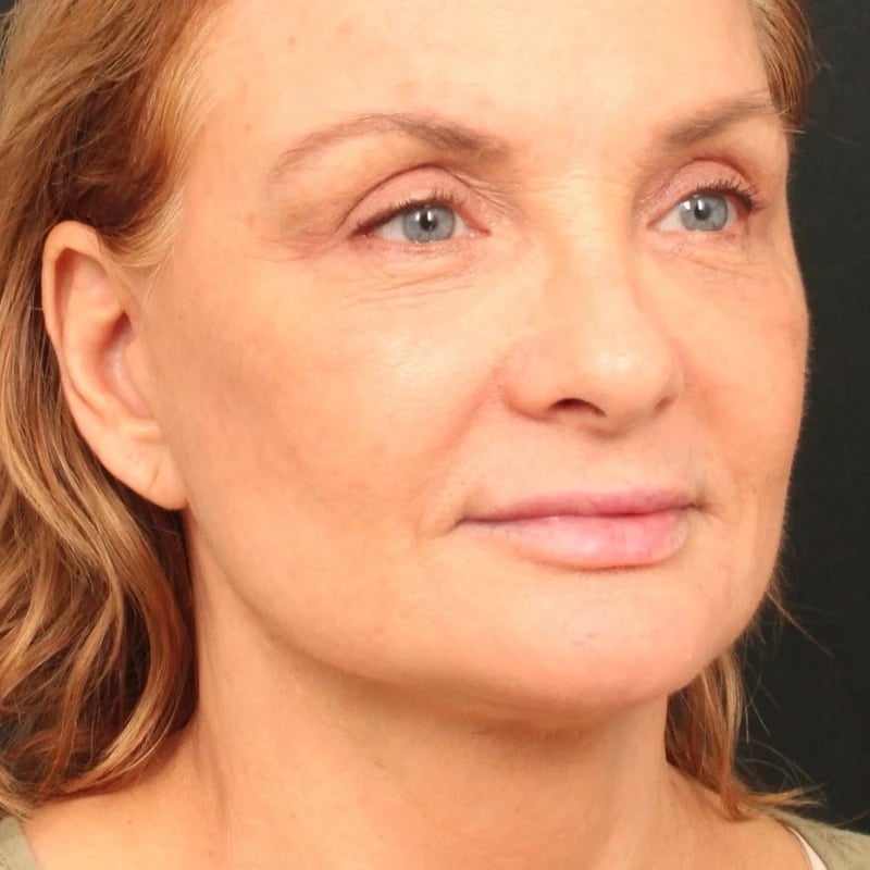 Deep Plane Facelift & Neck Lift Before & After Image