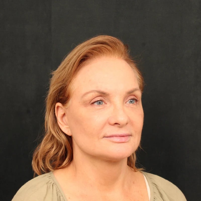 Deep Plane Facelift & Neck Lift Before & After Image