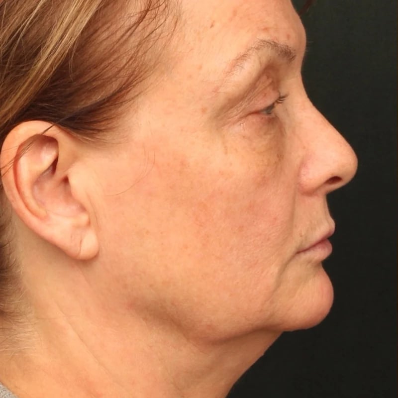 Deep Plane Facelift & Neck Lift Before & After Image