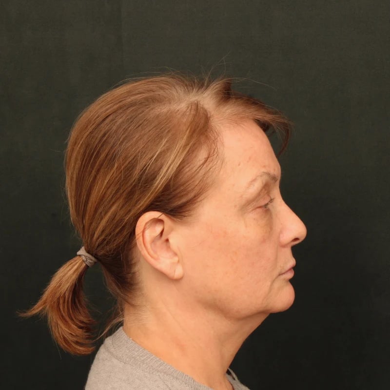 Deep Plane Facelift & Neck Lift Before & After Image