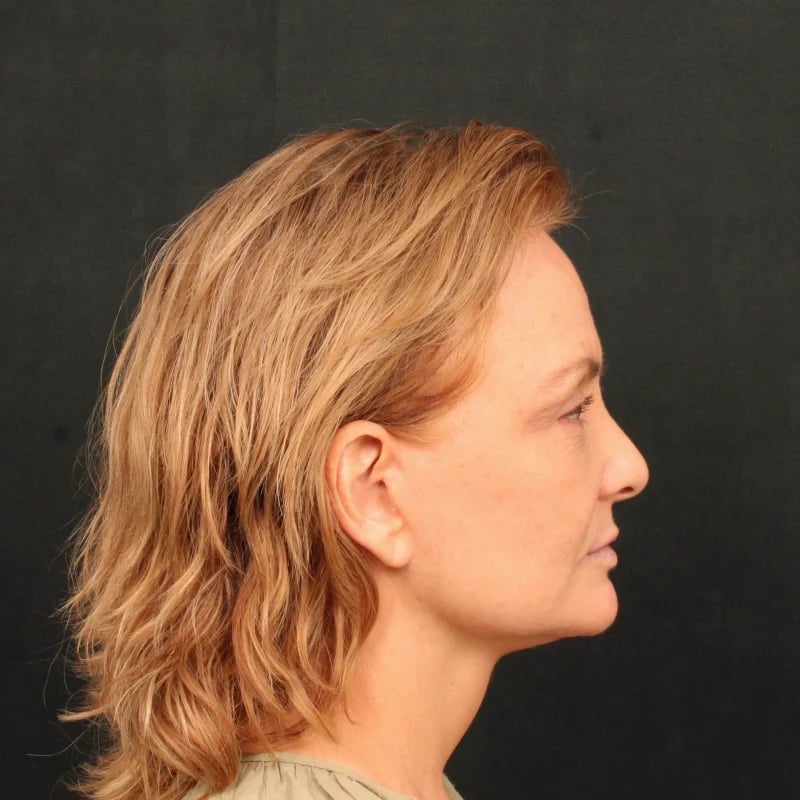 Deep Plane Facelift & Neck Lift Before & After Image