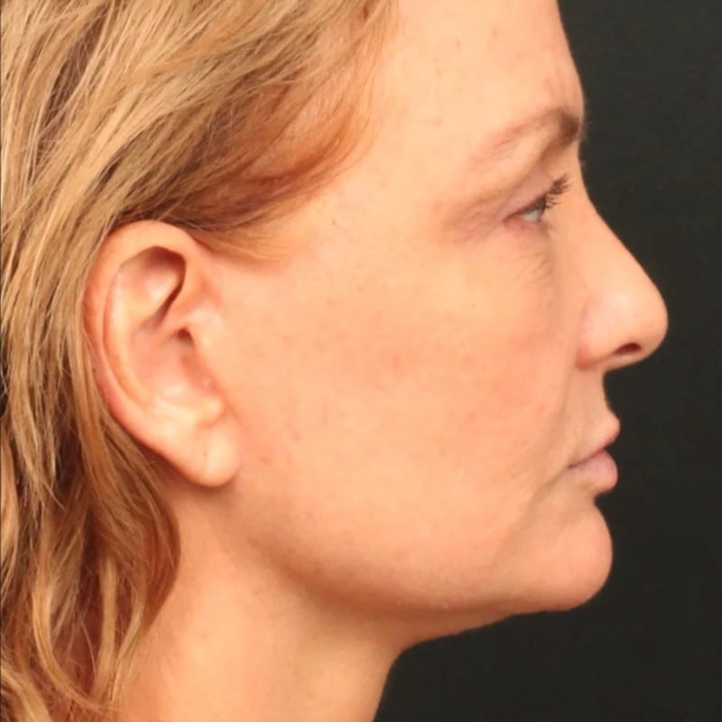 Deep Plane Facelift & Neck Lift Before & After Image