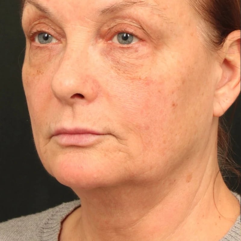 Deep Plane Facelift & Neck Lift Before & After Image