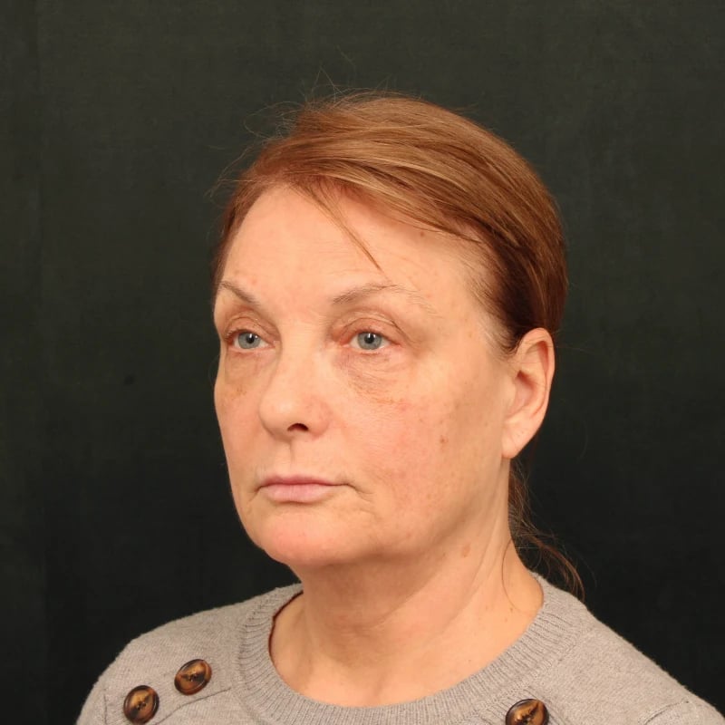 Deep Plane Facelift & Neck Lift Before & After Image