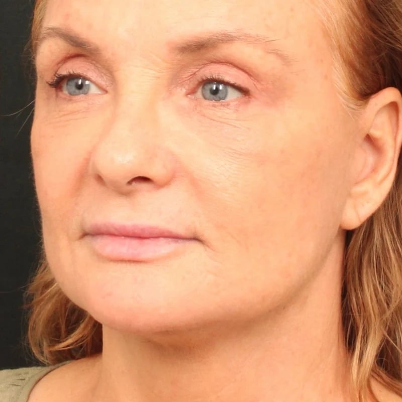 Deep Plane Facelift & Neck Lift Before & After Image