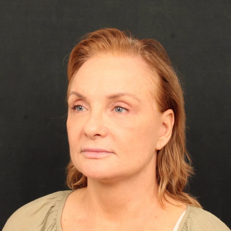Deep Plane Facelift & Neck Lift Before & After Image