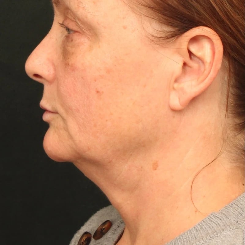 Deep Plane Facelift & Neck Lift Before & After Image
