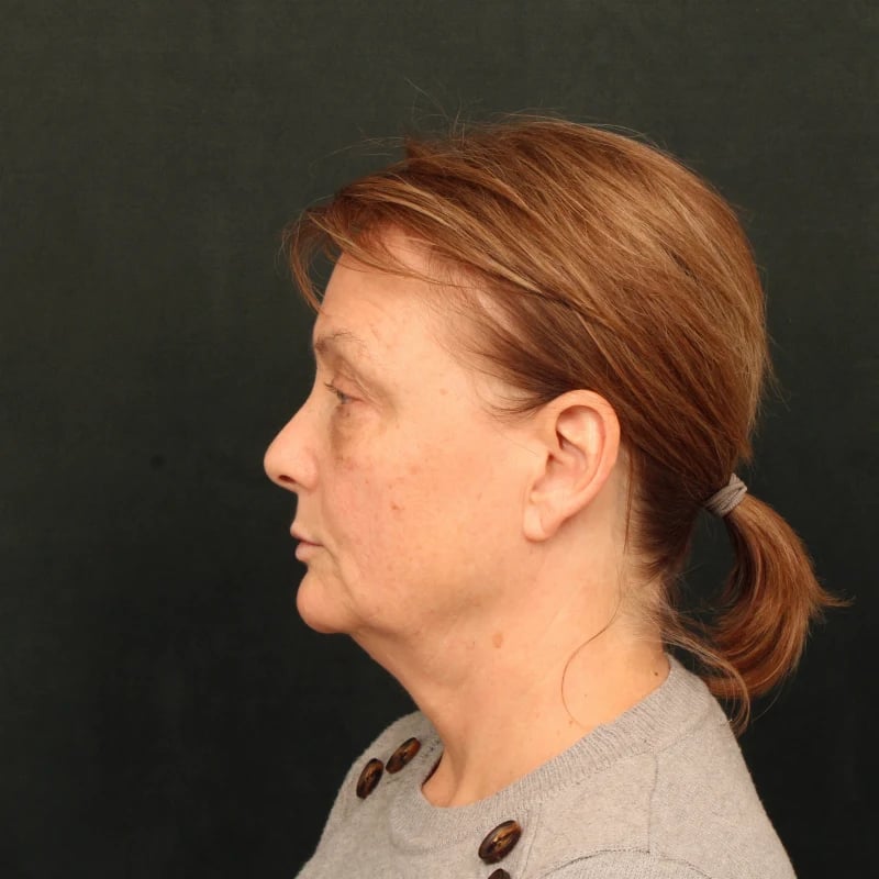 Deep Plane Facelift & Neck Lift Before & After Image