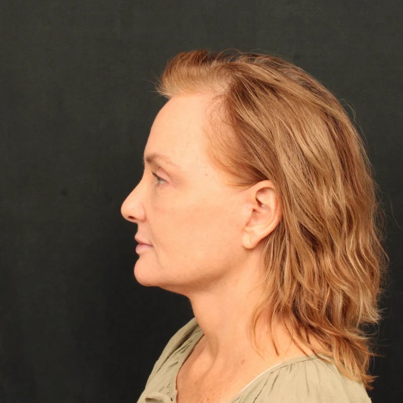 Deep Plane Facelift & Neck Lift Before & After Image