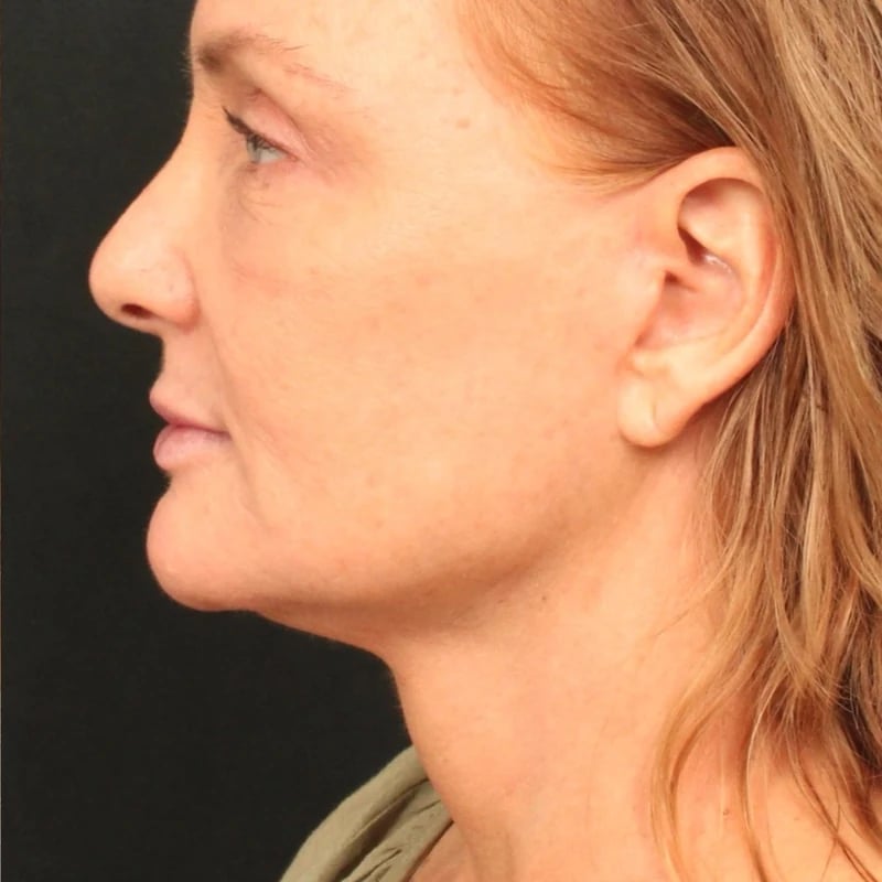 Deep Plane Facelift & Neck Lift Before & After Image