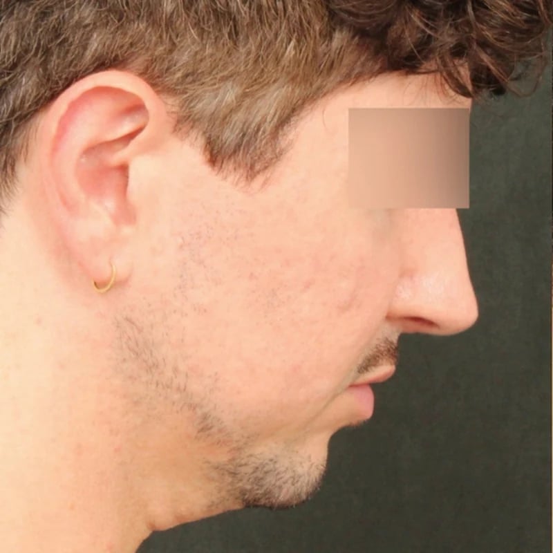 Deep Plane Facelift & Neck Lift Before & After Image