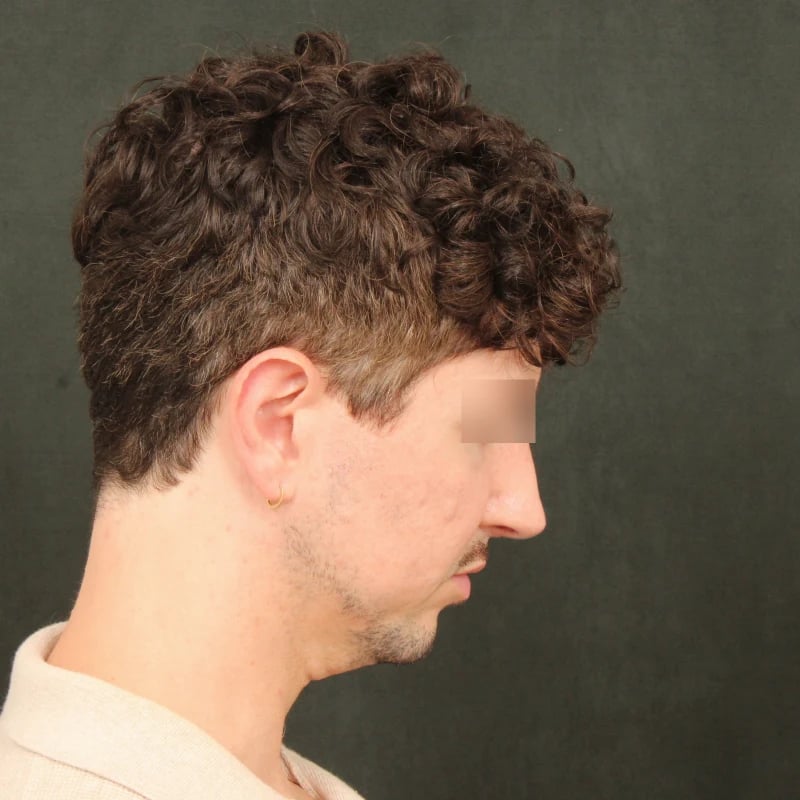 Deep Plane Facelift & Neck Lift Before & After Image