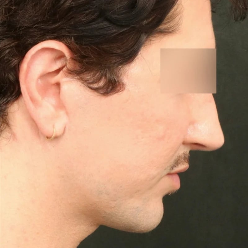 Deep Plane Facelift & Neck Lift Before & After Image
