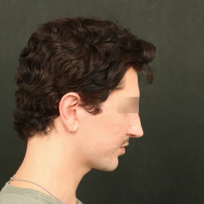 Deep Plane Facelift & Neck Lift Before & After Image