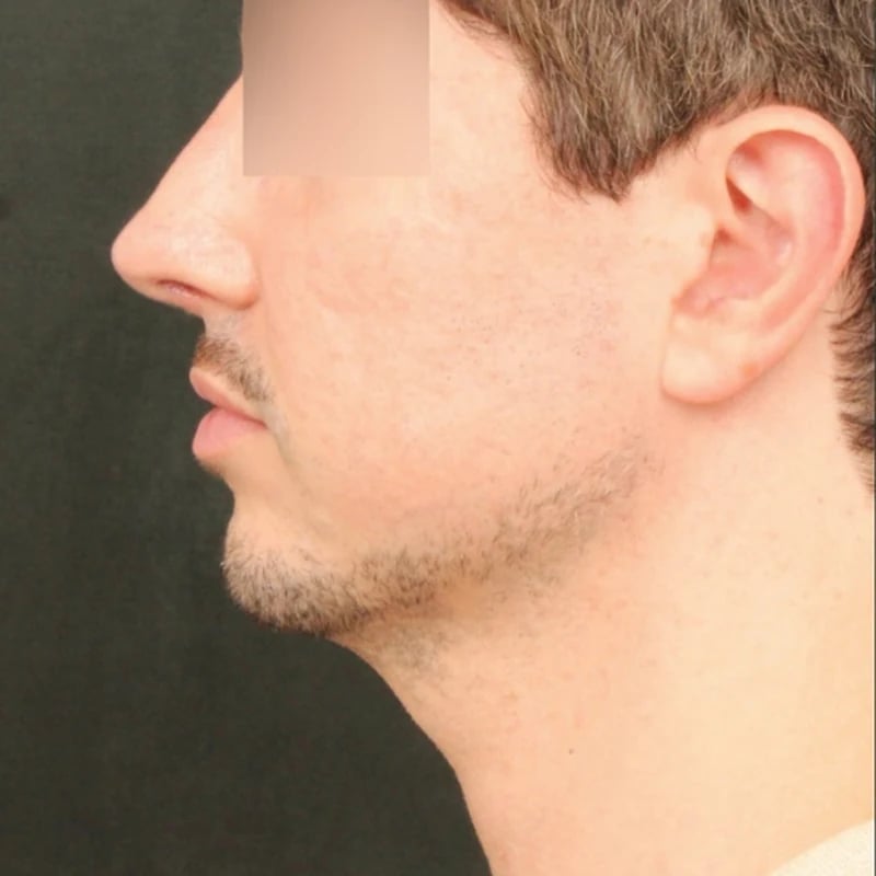 Deep Plane Facelift & Neck Lift Before & After Image
