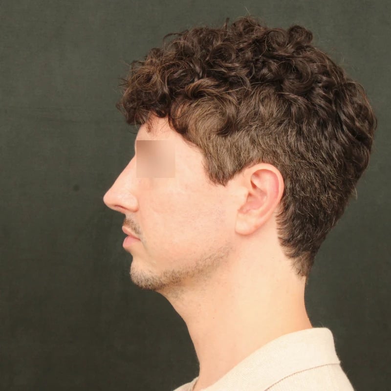 Deep Plane Facelift & Neck Lift Before & After Image