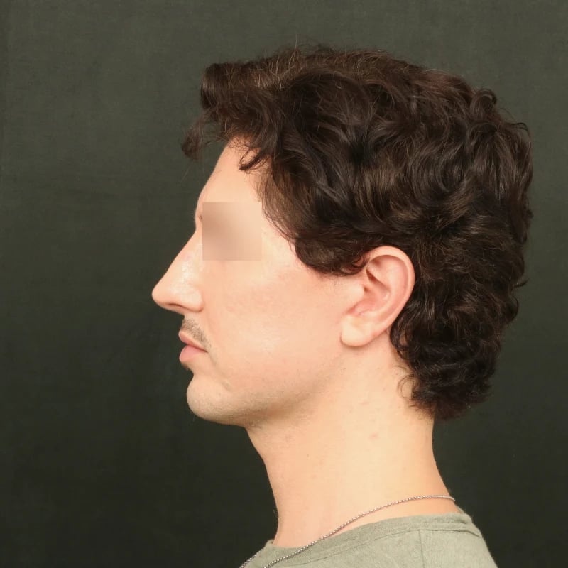 Deep Plane Facelift & Neck Lift Before & After Image