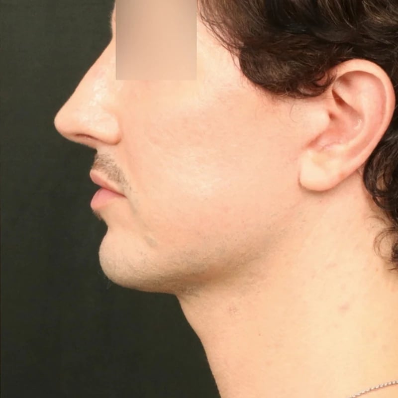 Deep Plane Facelift & Neck Lift Before & After Image