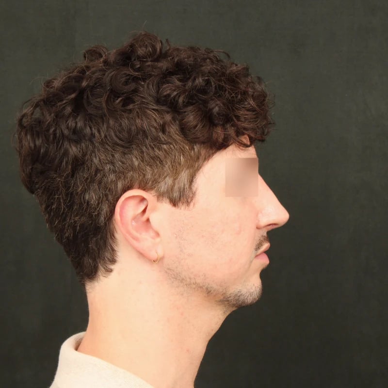 Deep Plane Facelift & Neck Lift Before & After Image