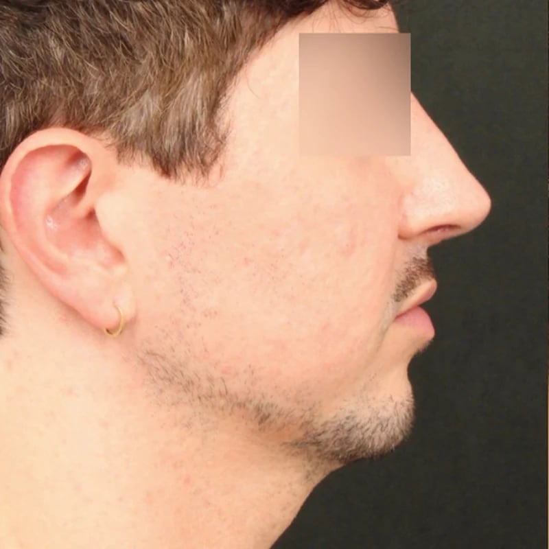 Deep Plane Facelift & Neck Lift Before & After Image