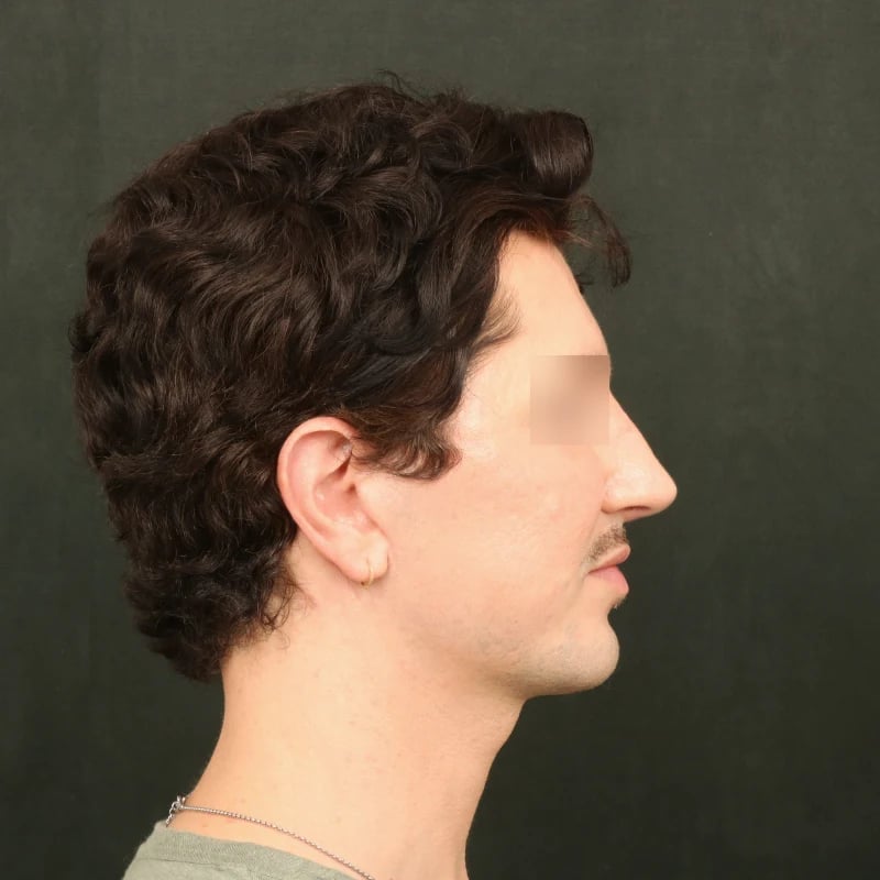 Deep Plane Facelift & Neck Lift Before & After Image