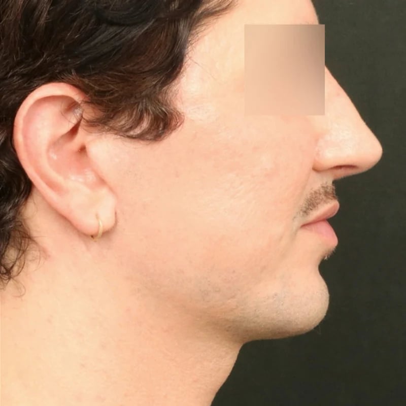 Deep Plane Facelift & Neck Lift Before & After Image