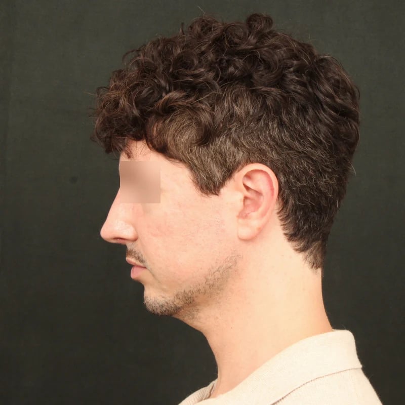 Deep Plane Facelift & Neck Lift Before & After Image