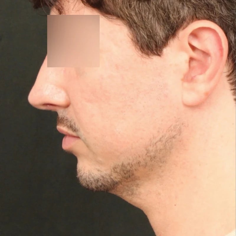 Deep Plane Facelift & Neck Lift Before & After Image