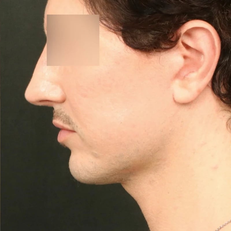 Deep Plane Facelift & Neck Lift Before & After Image