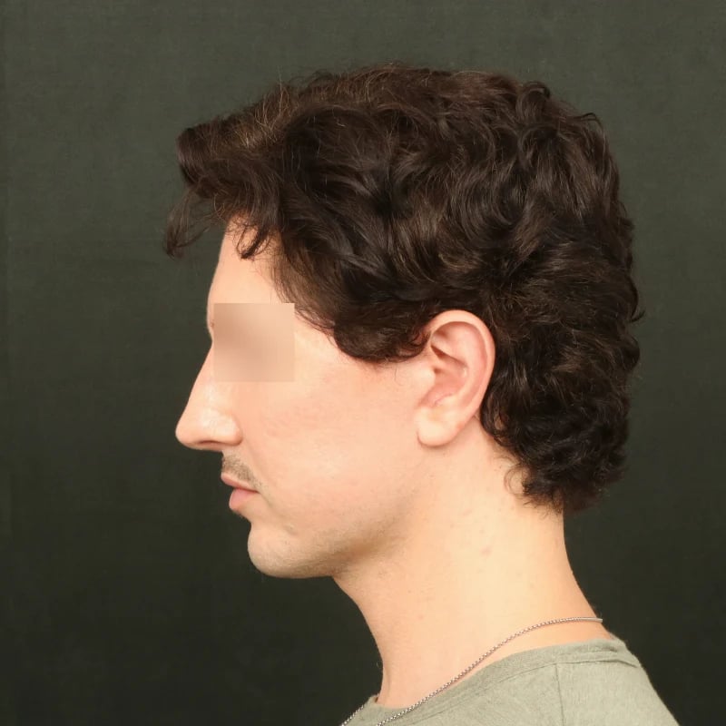 Deep Plane Facelift & Neck Lift Before & After Image