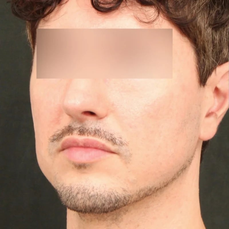 Deep Plane Facelift & Neck Lift Before & After Image