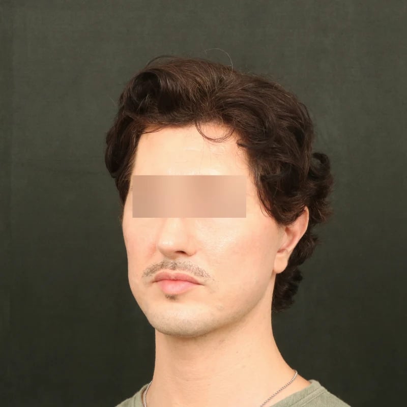 Deep Plane Facelift & Neck Lift Before & After Image