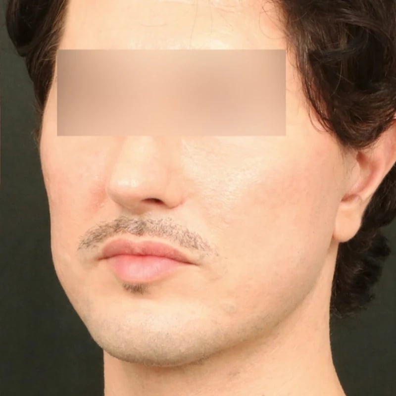 Deep Plane Facelift & Neck Lift Before & After Image