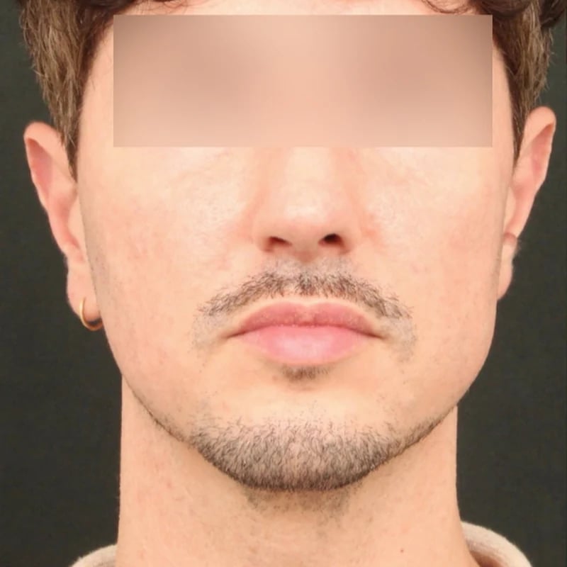 Deep Plane Facelift & Neck Lift Before & After Image