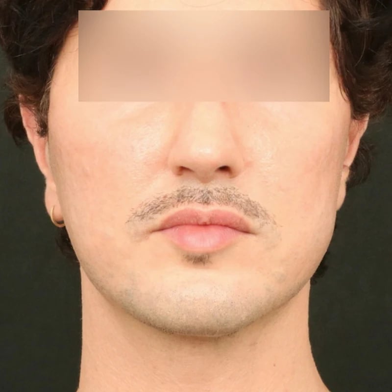 Deep Plane Facelift & Neck Lift Before & After Image