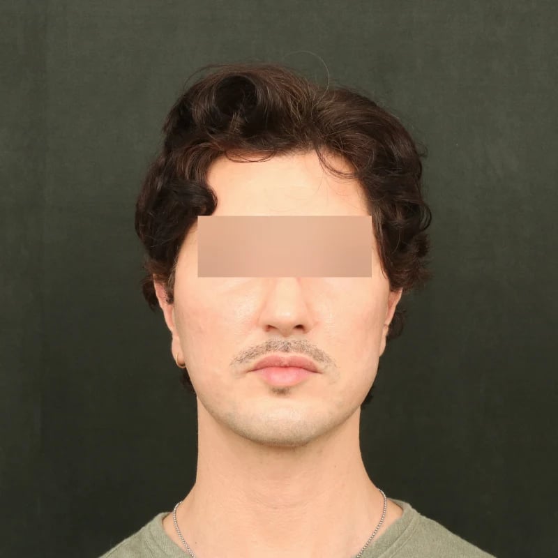 Deep Plane Facelift & Neck Lift Before & After Image