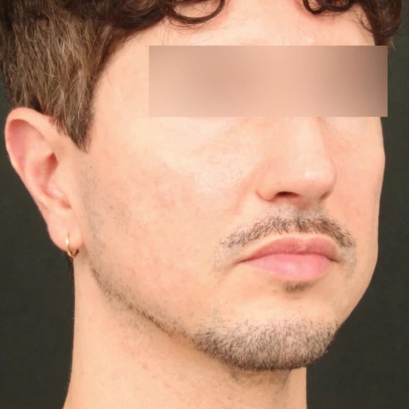 Deep Plane Facelift & Neck Lift Before & After Image