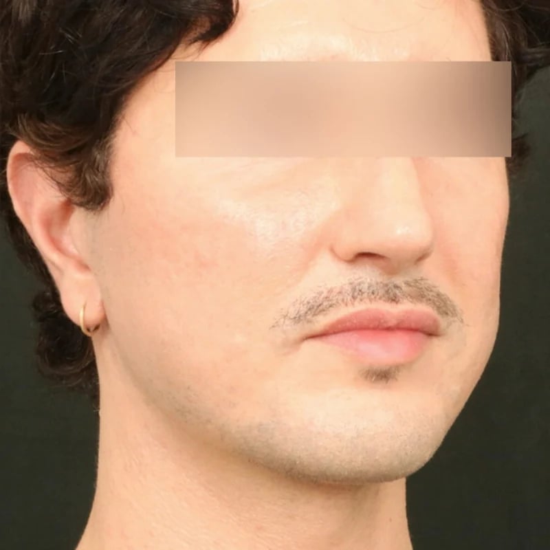 Deep Plane Facelift & Neck Lift Before & After Image