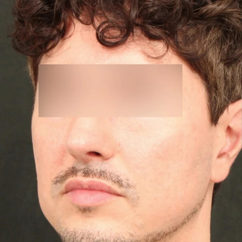 Fat Transfer Before & After Image