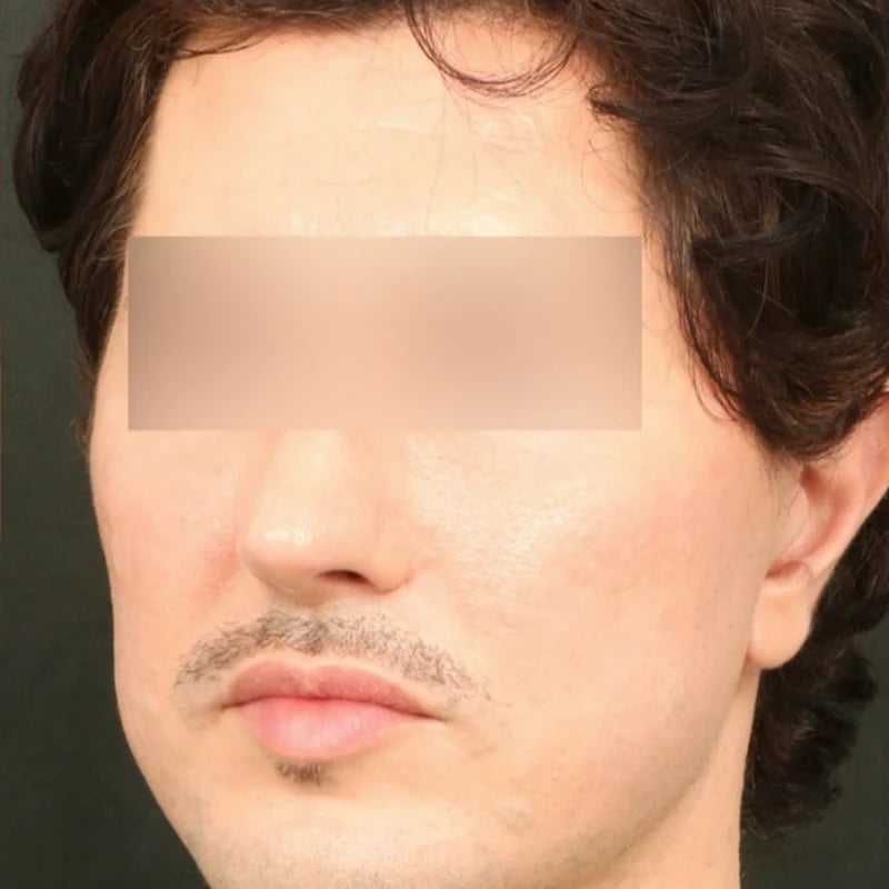 Fat Transfer Before & After Image