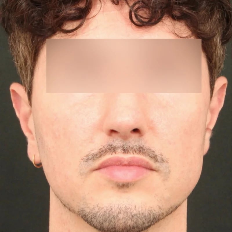 Fat Transfer Before & After Image
